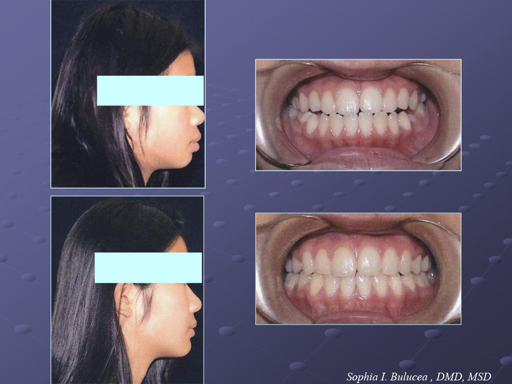 Before and After Cupertino Ortho Care and Kids Dentistry Cupertino CA