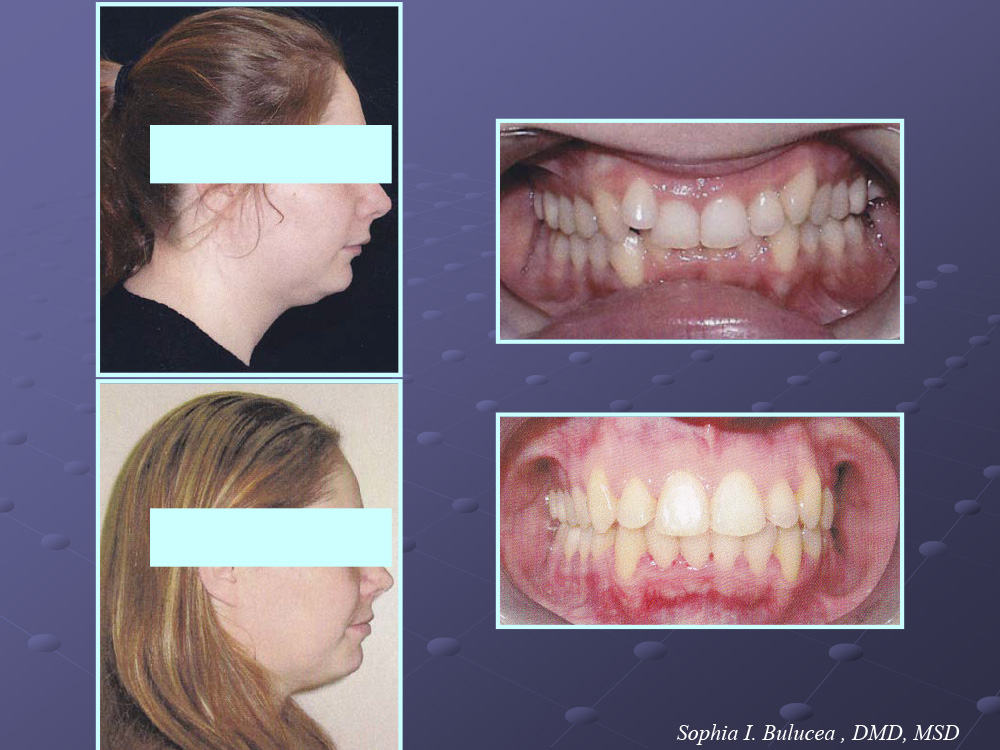 Before and After Cupertino Ortho Care and Kids Dentistry Cupertino CA