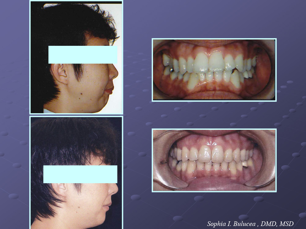 Before and After Cupertino Ortho Care and Kids Dentistry Cupertino CA