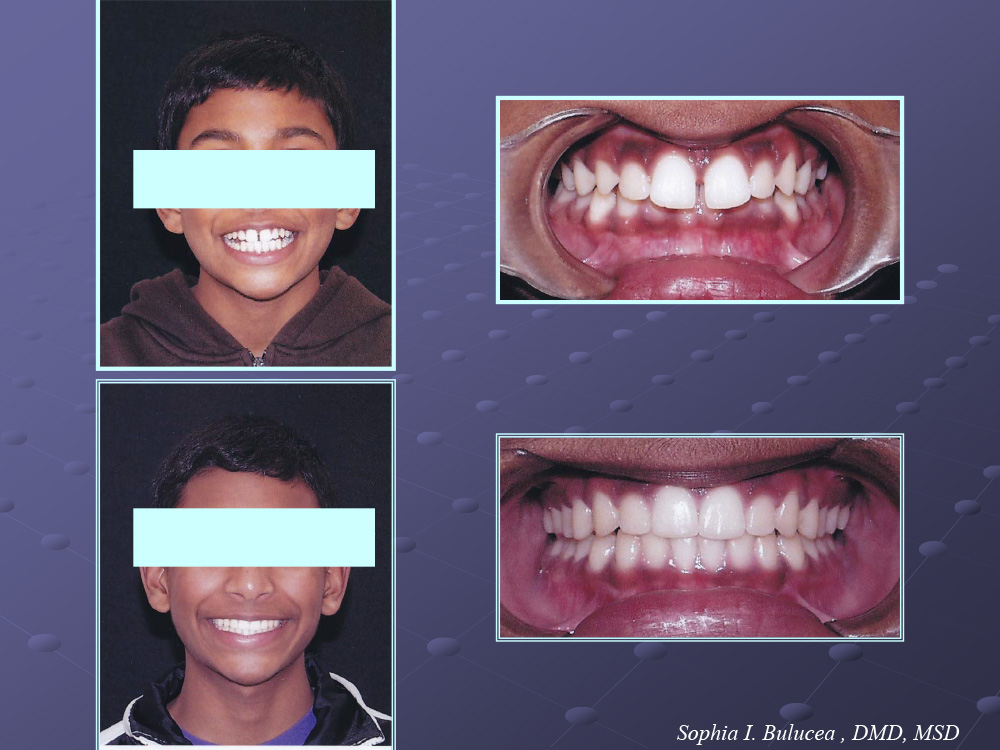 Before and After Cupertino Ortho Care and Kids Dentistry Cupertino CA