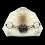 maxillary skeletal appliance